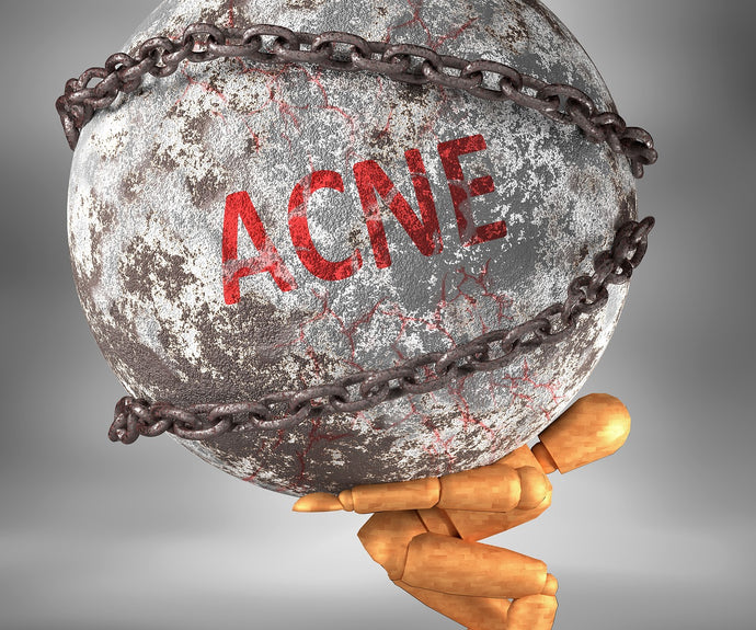 Understanding and Managing Back Acne